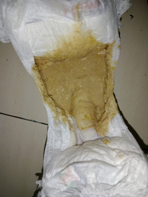Pernah tak sesiapa ada pengalaman anak buang air besar najis warna macam ni?