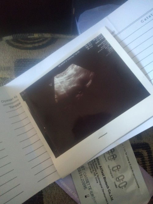 Hasil tespek samar di USG kata nya ga hamil