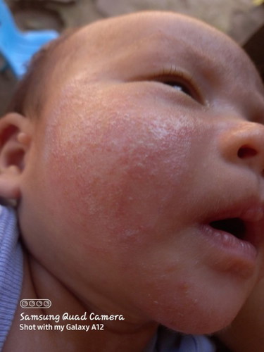 Magandang gamot sa eczema