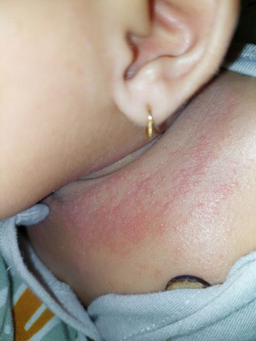 Beruntus dan merah pada leher bayi 3 bulan