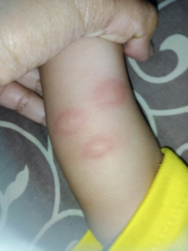 Cara ampuh mengobati bentol merah bayi dengan cepat dengan apa ya bun?