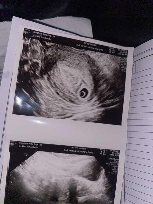 Kalo dari hpht sy kehamilan 6w4days tapi masih terlihat kantong + yolk sac saja.