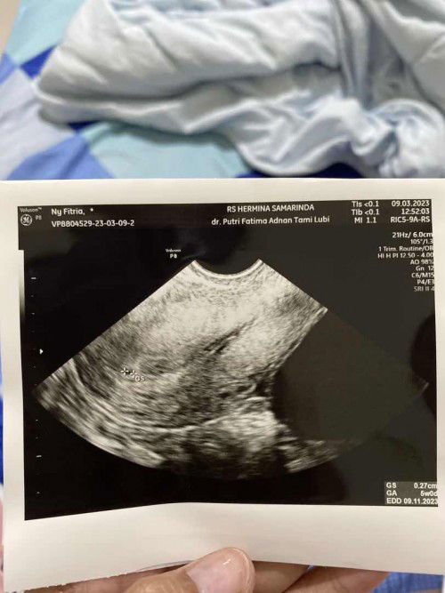 USG transvaginal terdeteksi kista