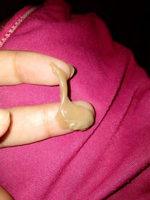 lendir coklat keluar dr miss V