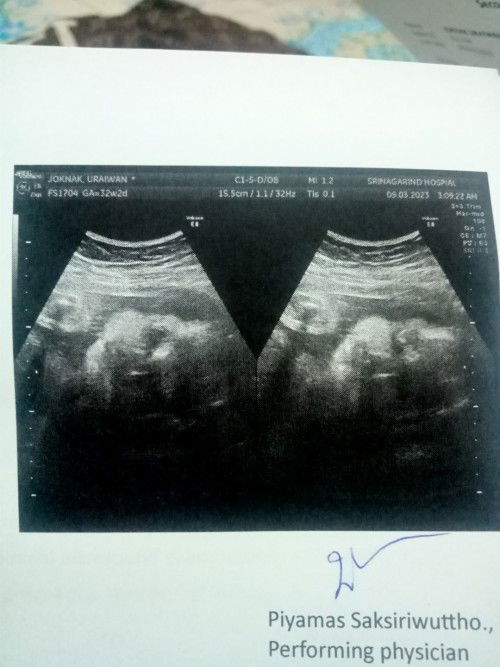 ตั้งครรภ์32+3 น้ำหนักแม่ขึ้นมา11 โลแล้วจ้า น้องเพศหญิง นะคะ