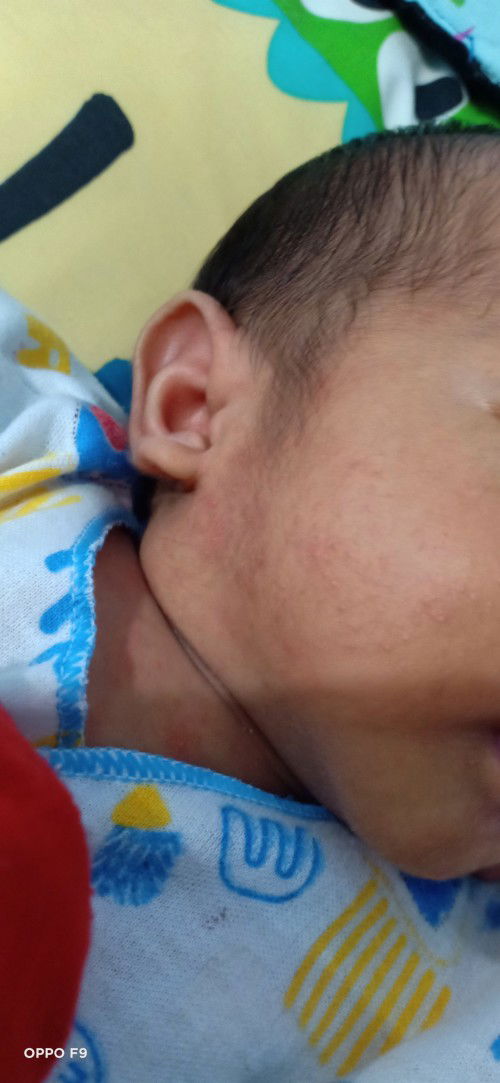 Bintik bintik merah dimuka /