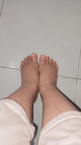 Hamil 25 minggu kaki bengkak