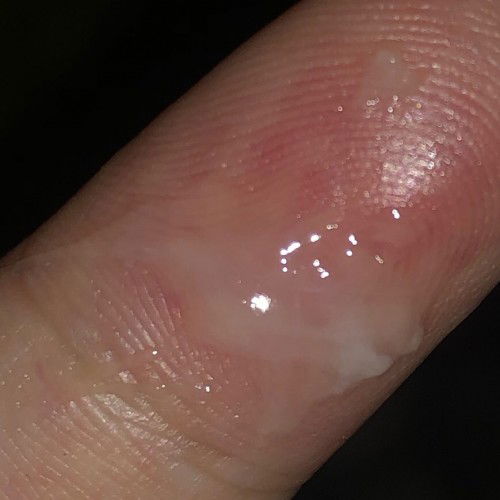 39+2w แบบนี้เรียกมูกปะคะ