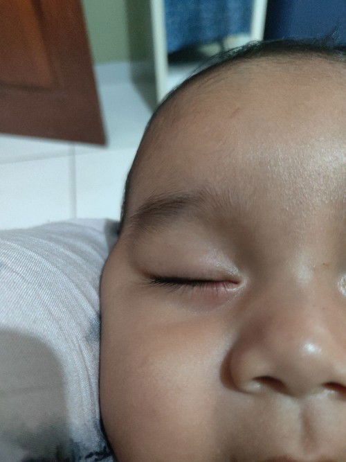 Sudut mata bengkak, memerah dan seperti ada jerawat, apakah bintitan (?)