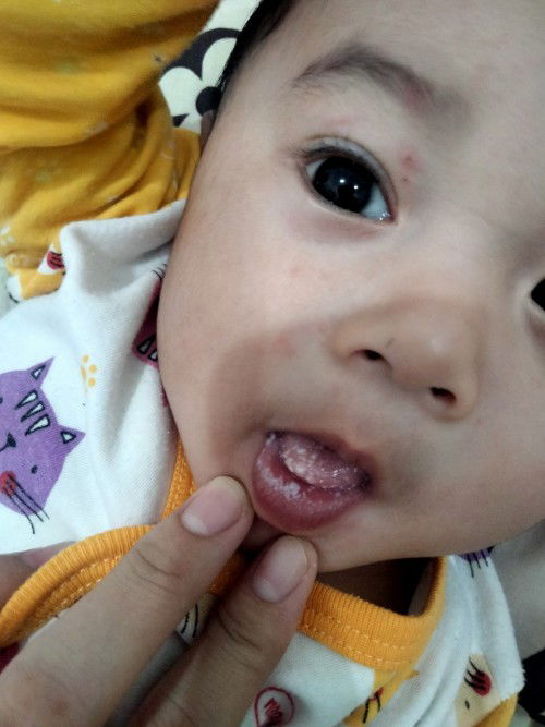 Bibir dan lidah bayi putih