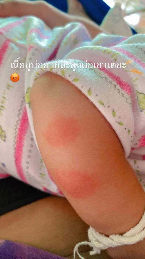 ตุ่มที่เเขนของลูก