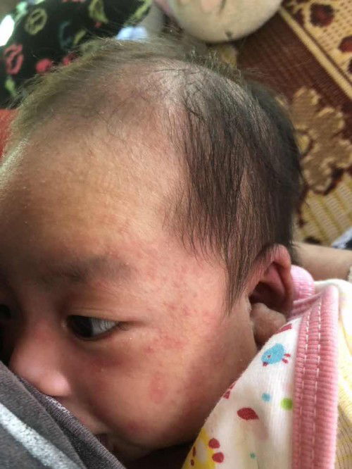 ลูกผื่นขึ้นหน้าา