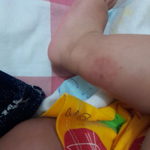 Obat di kaki bayi