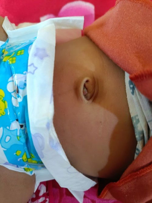 Benjolan kecil pada pusar bayi dan berair