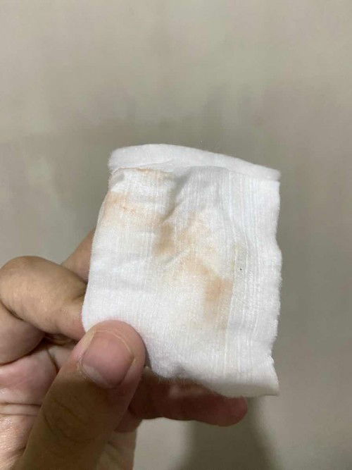 Keputihan Campur Darah