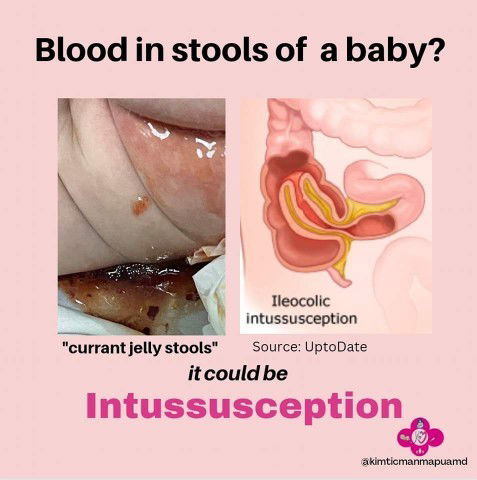 Blood in stool of baby