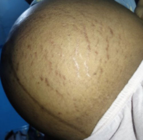 Keluar Stretchmark menjelang HPL