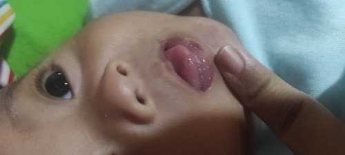 Bercak putih pada bibir bayi