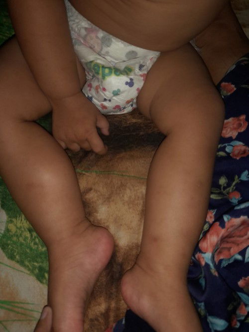 Ukuran betis beda sebelah