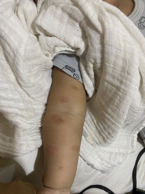 Ada tak krim nak hilangkan parut gigitan semut ni. Jadi hitam pulan