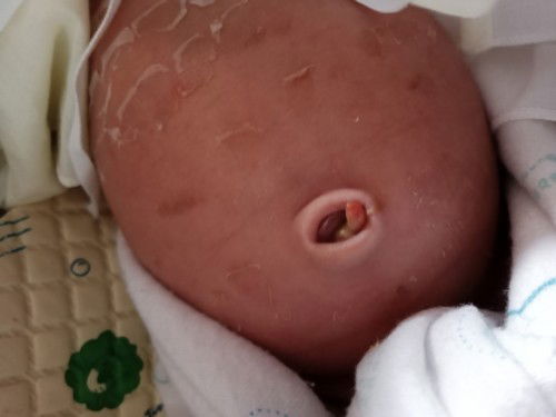 สะดือน้องหลุด