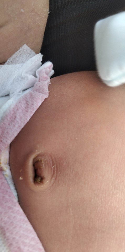 Mga mi bakit kaya nagtutubig pusod ni baby?