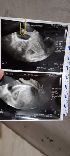 Hi mom, mau nnya hasil USG aku beda 2week cuma nmbh 1 week.. Kta dokter ikutin yg K2 ada yg sama kah