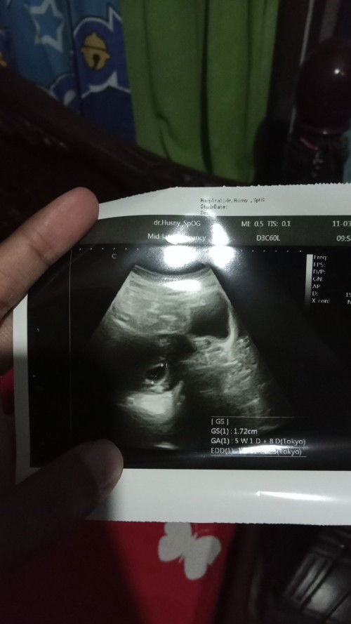 Bun hpht sama usg beda