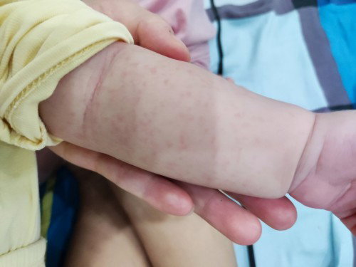 Bé nổi mẩn
