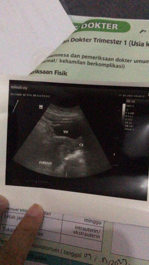 7 Week USG Abdomen belum terlihat kantung dan Janinnya