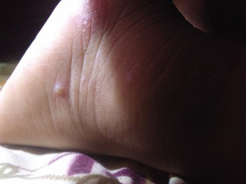 น้องเป็นอีสุกอีใส