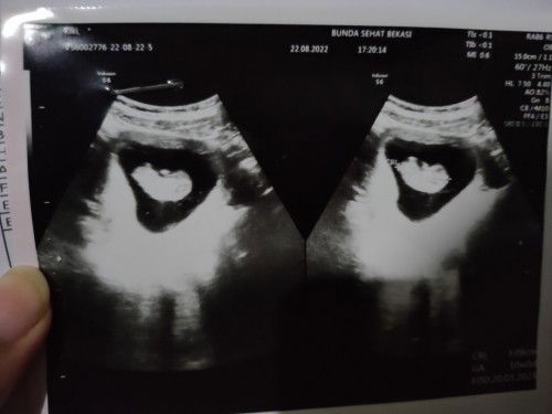 Bu, yg ngmbg itu USG ank 1 tpi TDK brkmbg.Nh 1nya fto skrg tp TDK ngmbg.Psisi kpla jg bda. Ngrh Tdk?