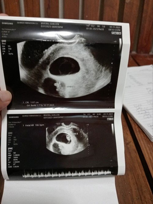 TWINS pero sa unang ultrasound Wala Nakitang laman sa Isang sac then after 2 weeks nagpa ultrasound