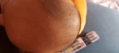 Biji² kecil benanah di kulit kepala bayi 1 bulan
