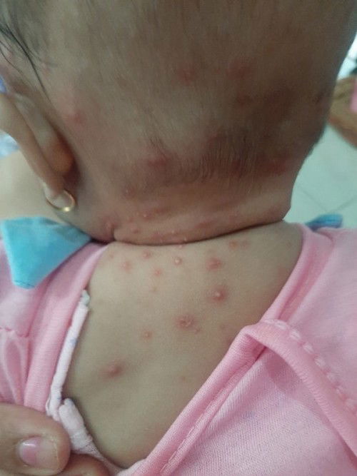 Jamur/alergi/iritasi