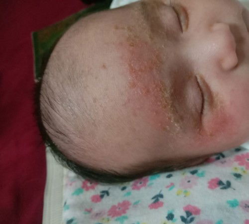 Bintik merah pada bayi