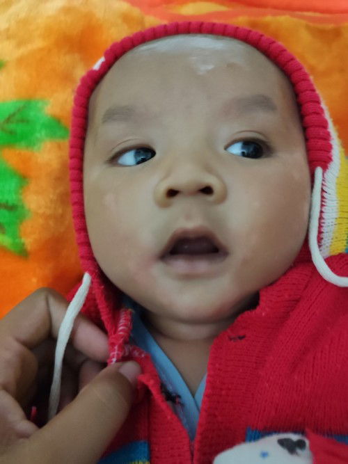 Ruam putih tapi bukan panu