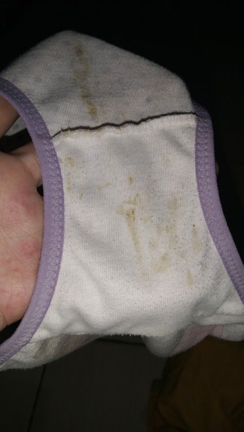 Cairan berwarna hijau dan bau tak sedap pada kemaluan anak perempuan umur 5 tahun