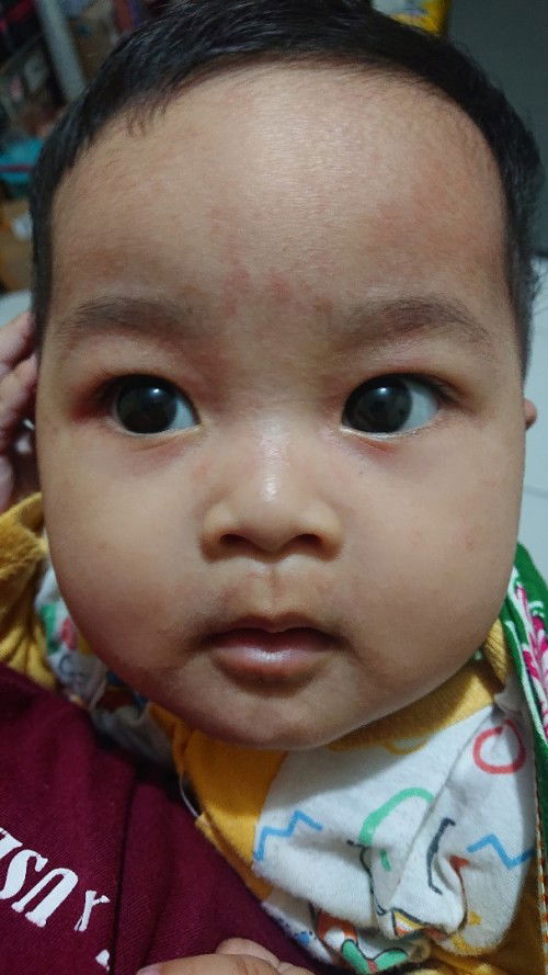 ini ruam atau alergi?