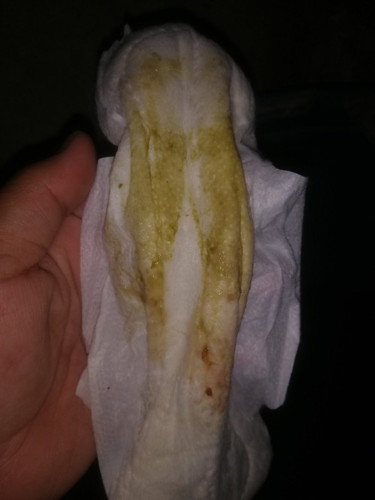 Normal lng po b ung discharge na ganyn kda iihi po may nalbas at maskit po ang bndng puson