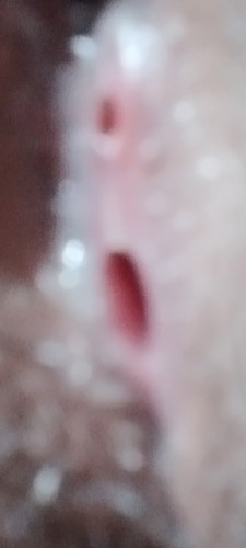 Normal lang poba na may butas ung tahi po kinakabahan po ako 1month 2weeks napo tahi ko