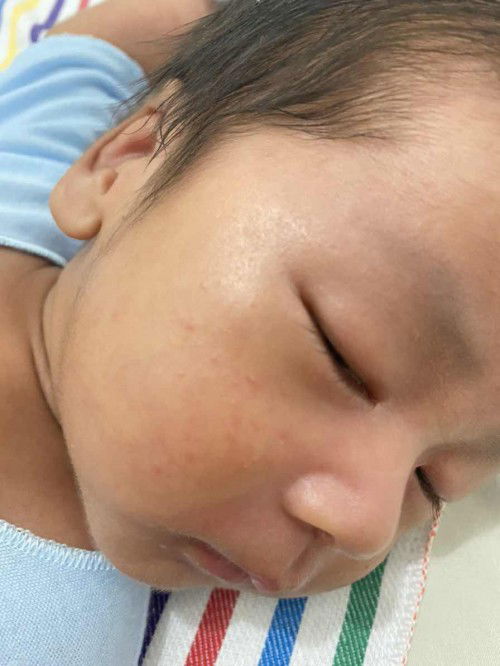 Bintik merah di pipi bayi