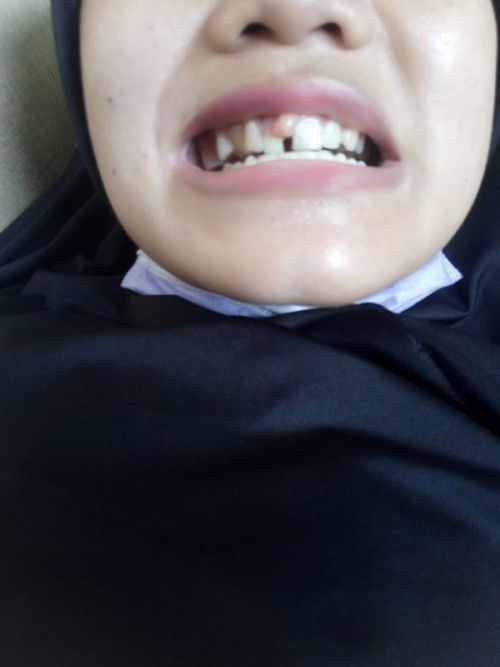 Tumbuh daging digusi saat hamil