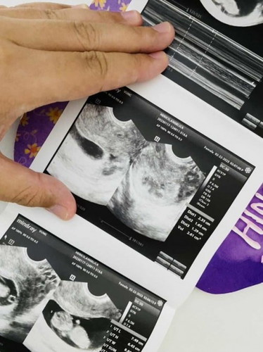 Subchorionic Hemorrhage