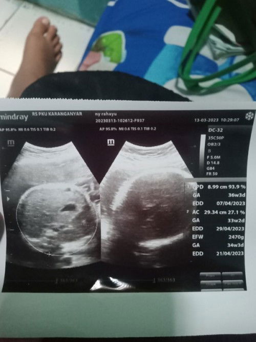 Hasil usg kehamilan
