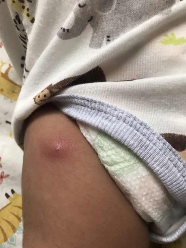 First Vaccine
