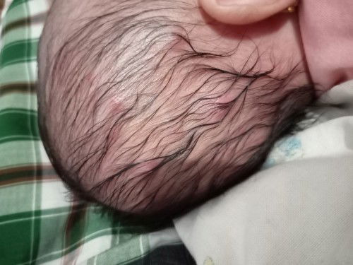 Bagaimana Cara mengobati bisulan di kepala bayi umur 2 bulan