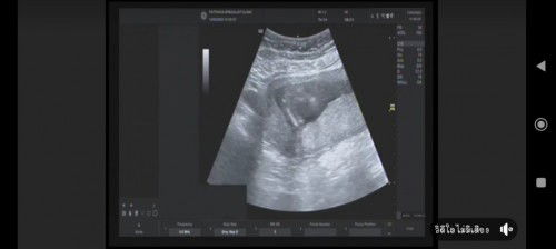 ช่วยดูหน่อยค่ะ 15w5dแล้วค่ะ