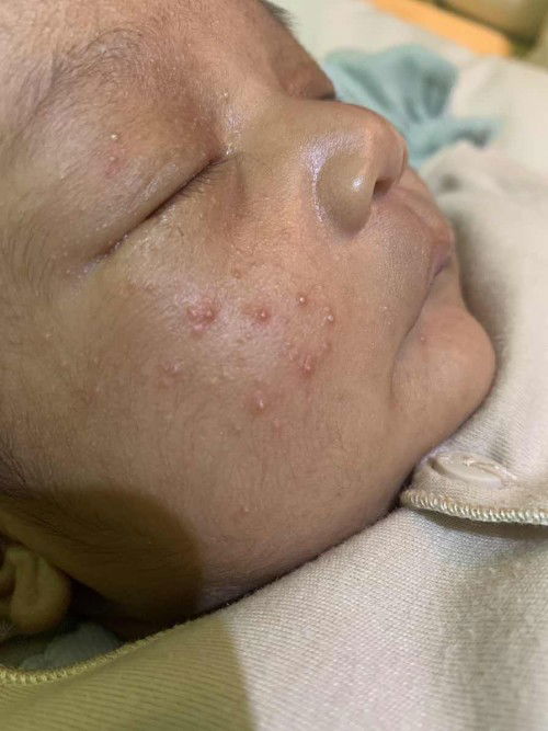 Bintik2 di kulit bayi