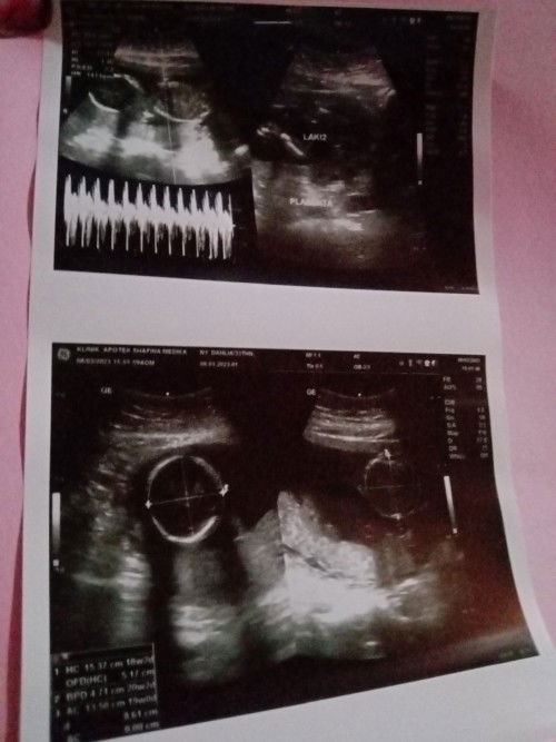 Alhamdulillah bund..kemrin dari usg usia kehamilan 18 minggu..semuax normal😘😘😘